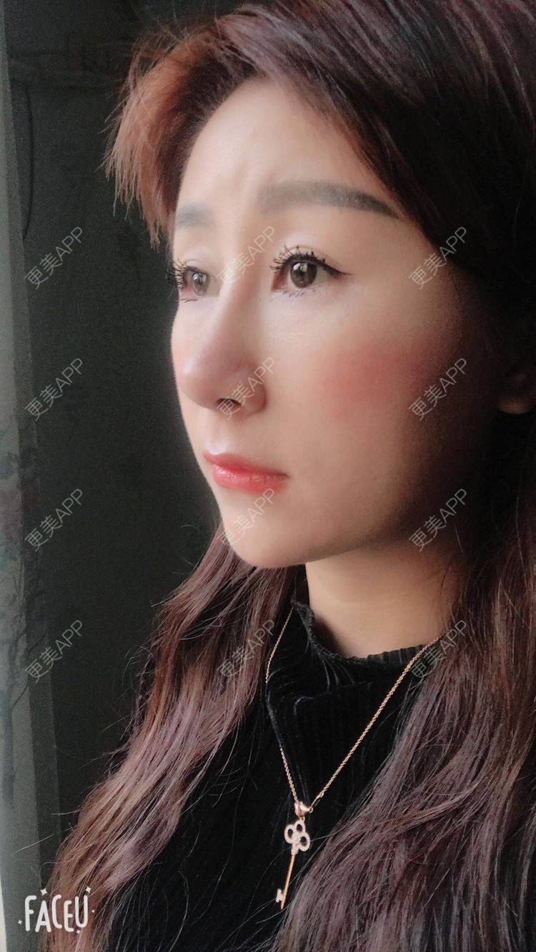更美 - 更美用户A29SpkoKUU的手术缩鼻头经验 | 手术缩鼻头 | 上海
