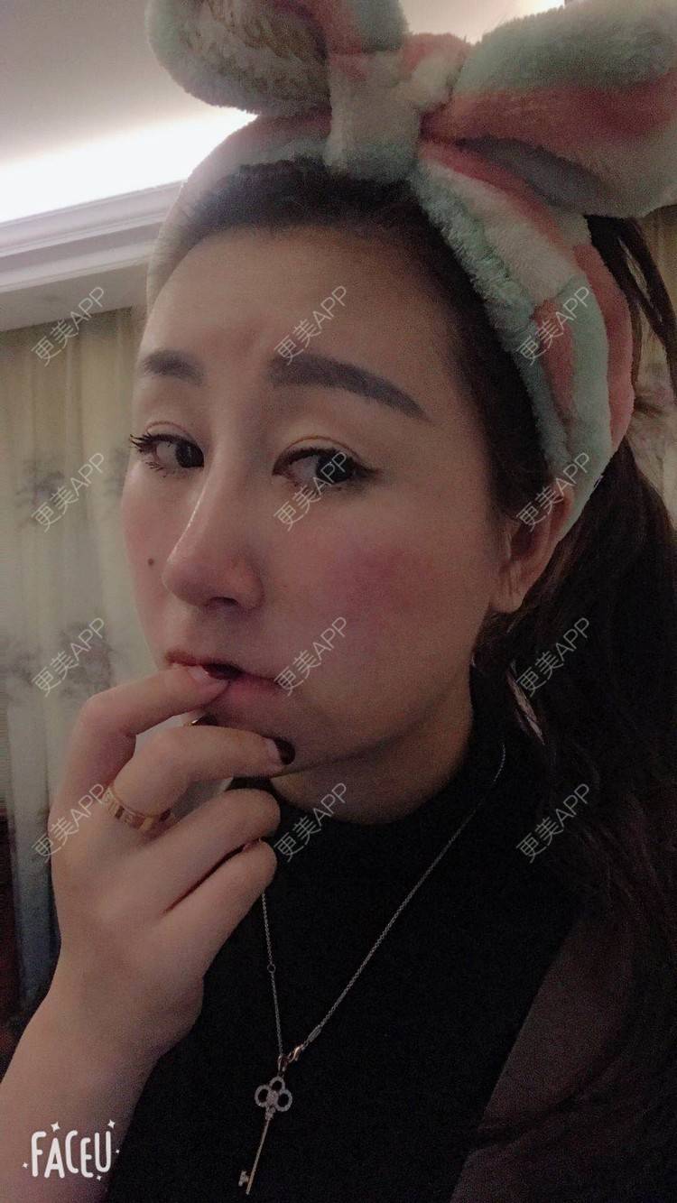 更美 - 更美用户A29SpkoKUU的手术缩鼻头经验 | 手术缩鼻头 | 上海