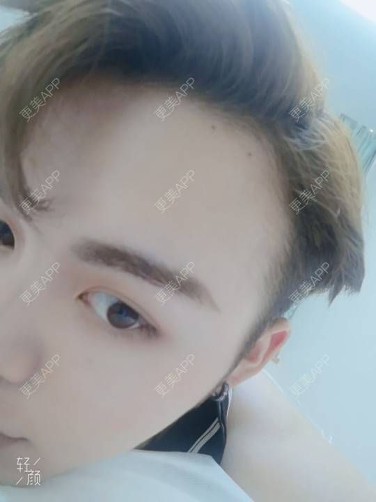 更美 - 更美用户rLJusWfgfC的面部脱毛经验 | 面部脱毛 | 武汉