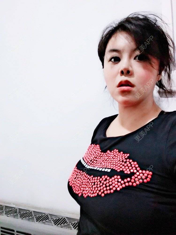 丰胸(隆胸) | 自体脂肪隆胸 | 假体隆胸 | 胶原蛋白丰胸 | 玻尿酸隆胸