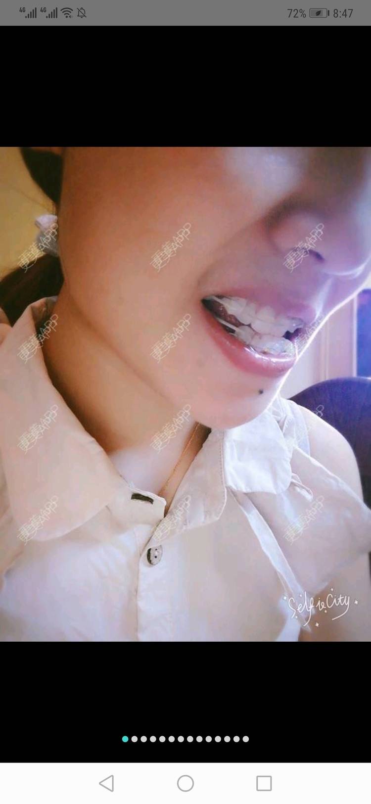 更美 - 更美用户yWgR3M4ypQ的牙齿矫正经验 | 视频日记 | 牙齿矫正 | 上海 | 美购日记