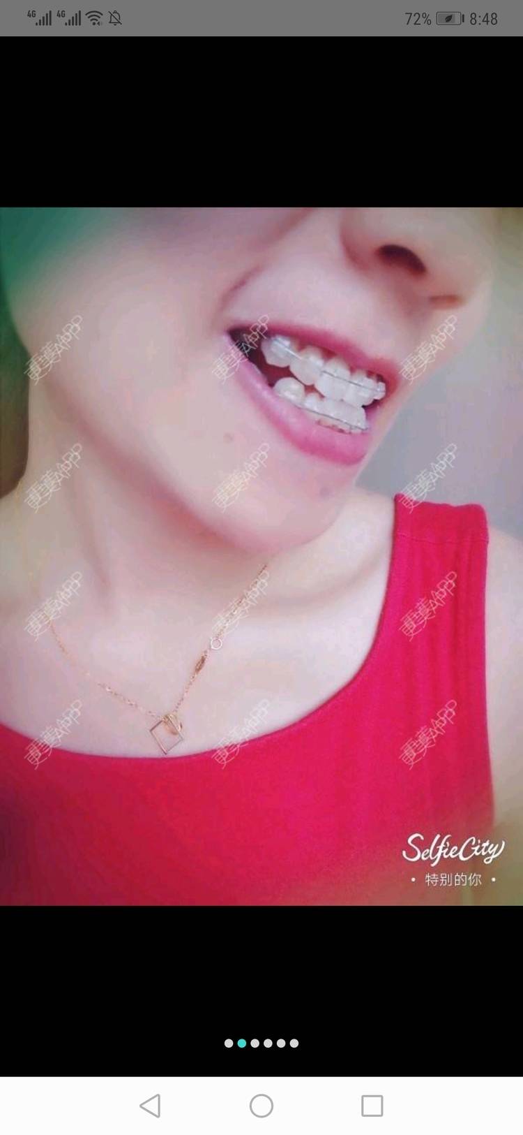 更美 - 更美用户yWgR3M4ypQ的牙齿矫正经验 | 视频日记 | 牙齿矫正 | 上海 | 美购日记