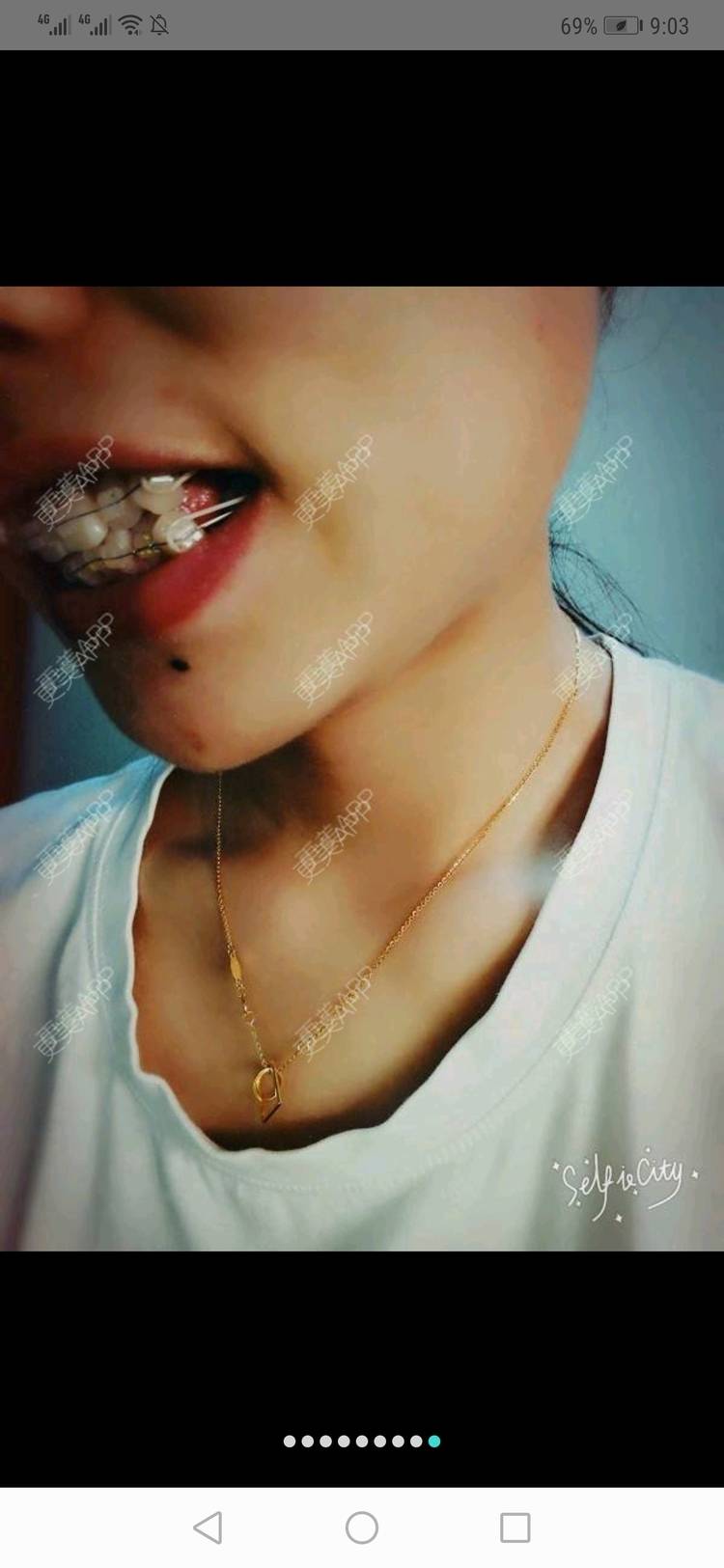 更美 - 更美用户yWgR3M4ypQ的牙齿矫正经验 | 视频日记 | 牙齿矫正 | 上海 | 美购日记