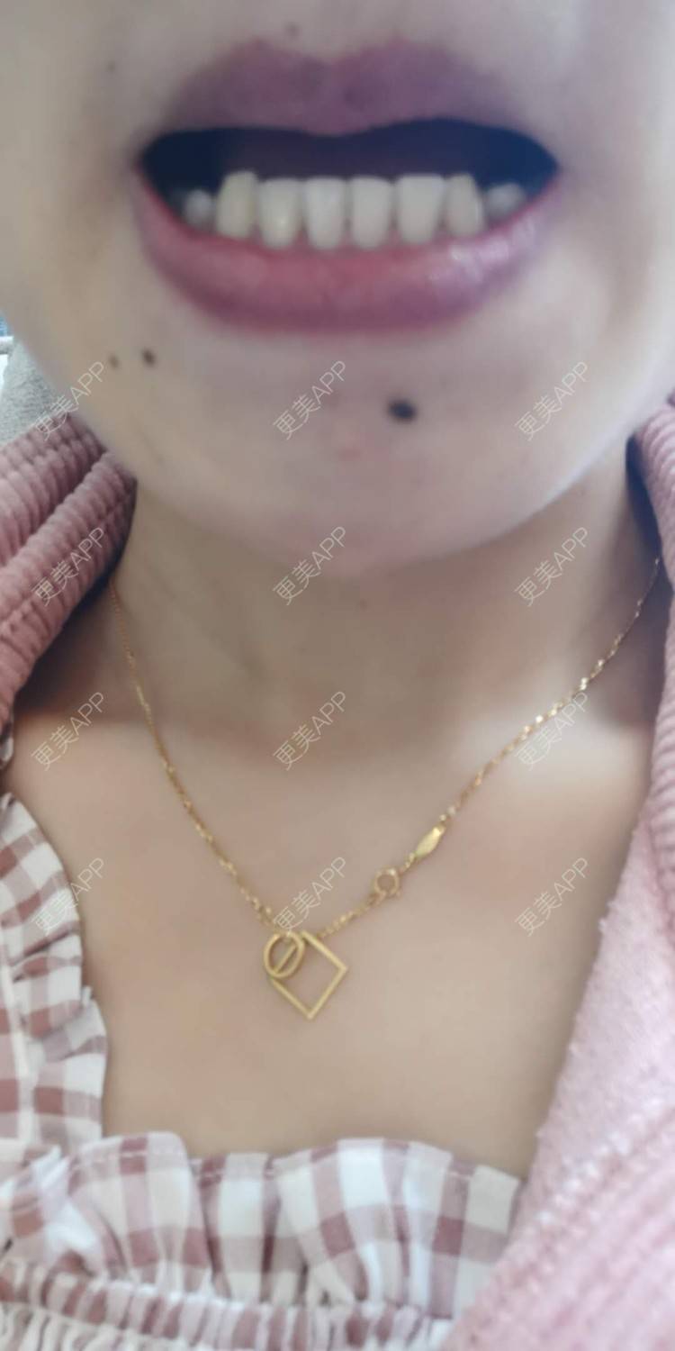 更美 - 更美用户yWgR3M4ypQ的牙齿矫正经验 | 视频日记 | 牙齿矫正 | 上海 | 美购日记