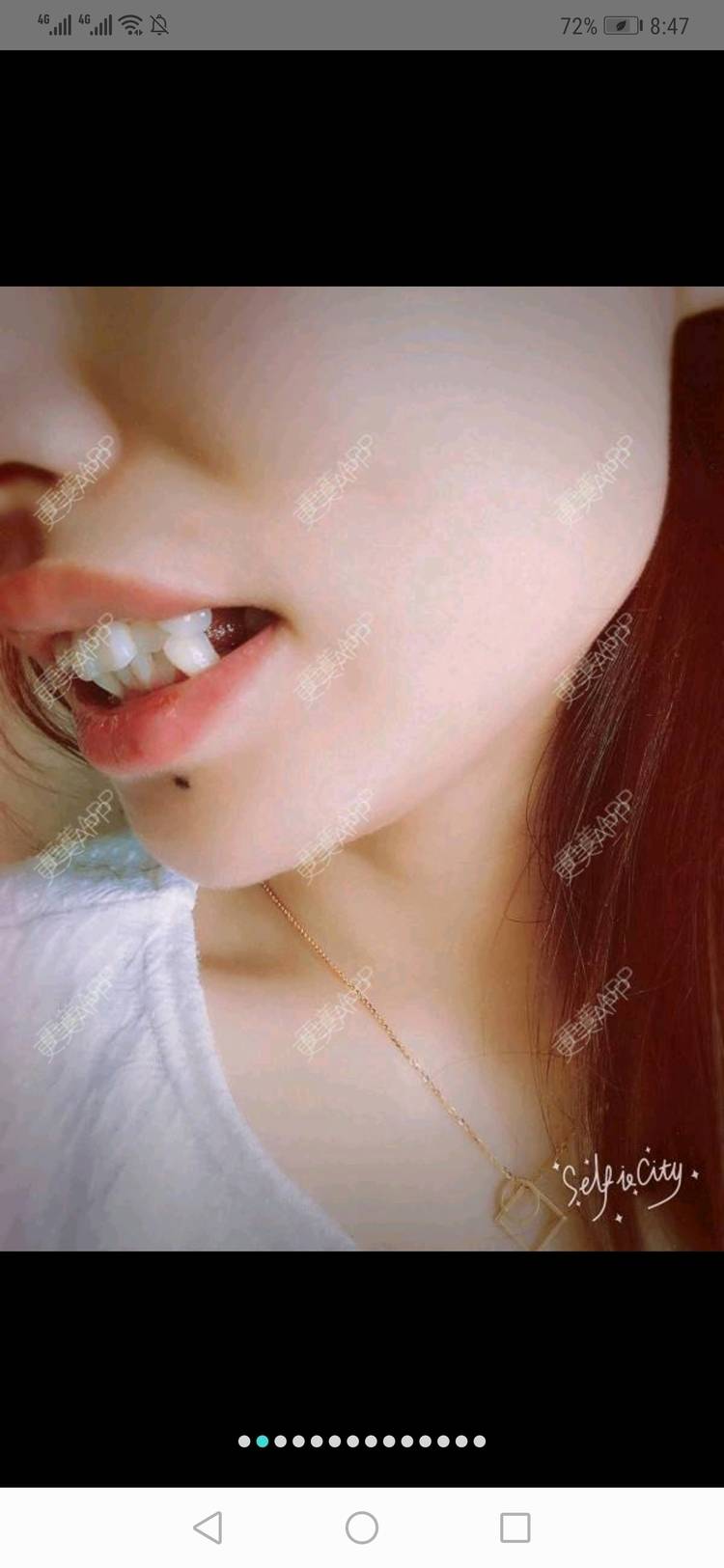 更美 - 更美用户yWgR3M4ypQ的牙齿矫正经验 | 视频日记 | 牙齿矫正 | 上海 | 美购日记