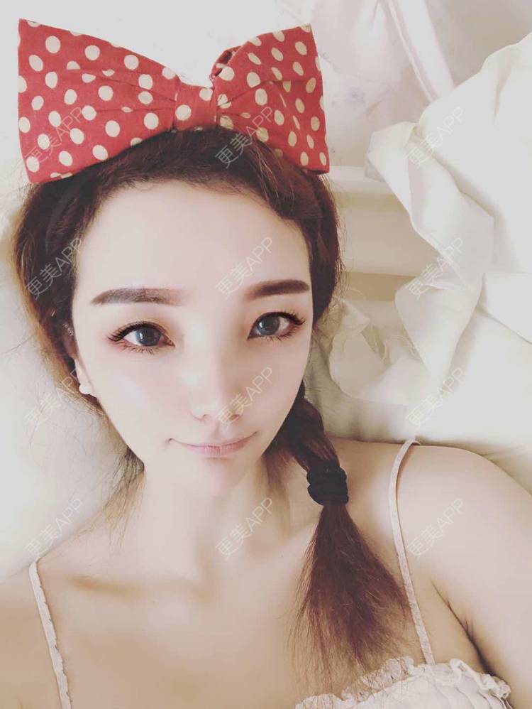 更美 - 更美用户EWqDuvHmIb的自体脂肪丰面颊经验 | 自体脂肪丰面颊 | 成都