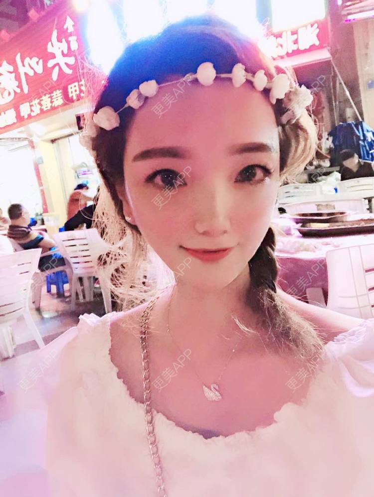 更美 - 更美用户EWqDuvHmIb的自体脂肪丰面颊经验 | 自体脂肪丰面颊 | 成都