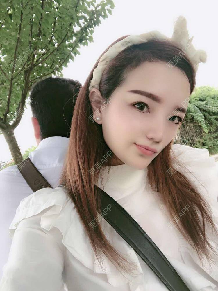 更美 - 更美用户EWqDuvHmIb的自体脂肪丰面颊经验 | 自体脂肪丰面颊 | 成都