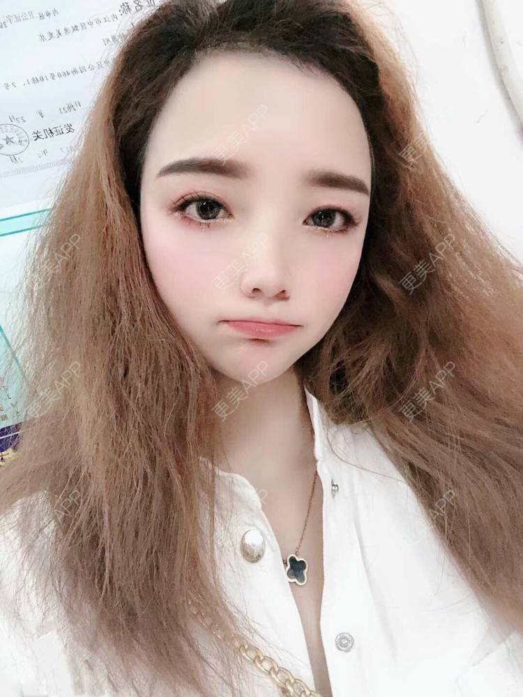 更美 - 更美用户EWqDuvHmIb的自体脂肪丰面颊经验 | 自体脂肪丰面颊 | 成都