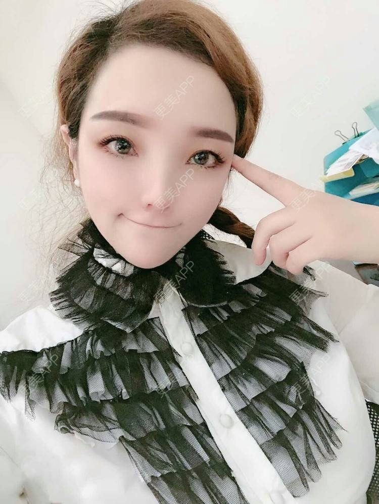 更美 - 更美用户EWqDuvHmIb的自体脂肪丰面颊经验 | 自体脂肪丰面颊 | 成都