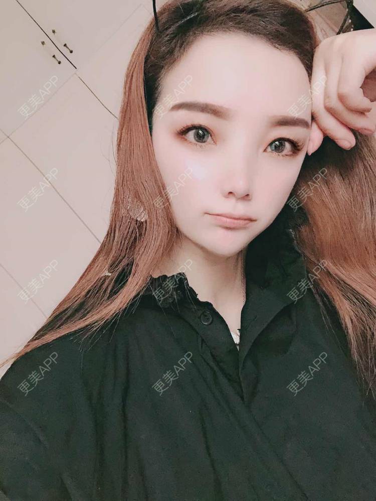 更美 - 更美用户EWqDuvHmIb的自体脂肪丰面颊经验 | 自体脂肪丰面颊 | 成都