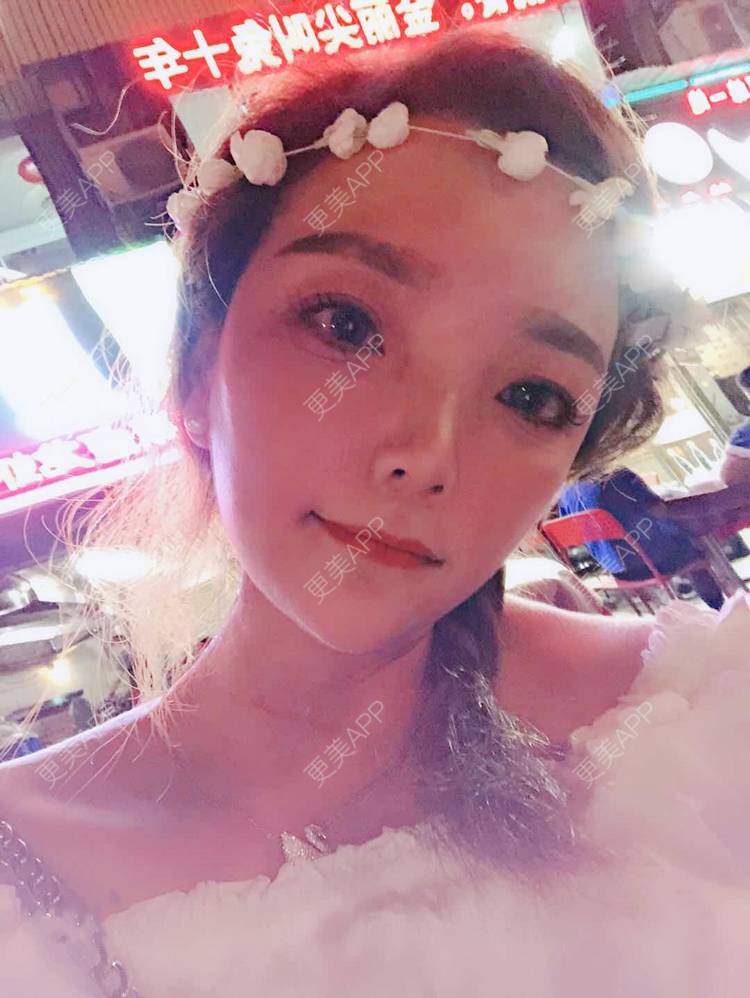 更美 - 更美用户EWqDuvHmIb的自体脂肪丰面颊经验 | 自体脂肪丰面颊 | 成都