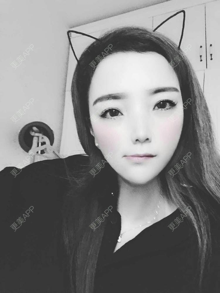 更美 - 更美用户EWqDuvHmIb的自体脂肪丰面颊经验 | 自体脂肪丰面颊 | 成都