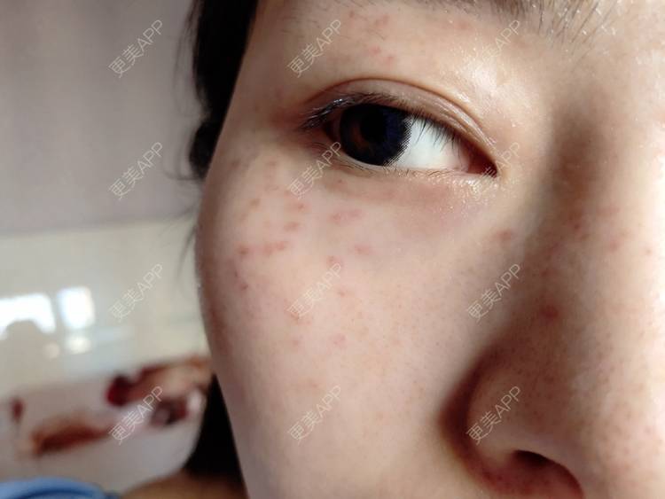 更美 - 更美用户mXMhmCcUCG的皮秒激光经验 | 重庆 | 皮秒激光