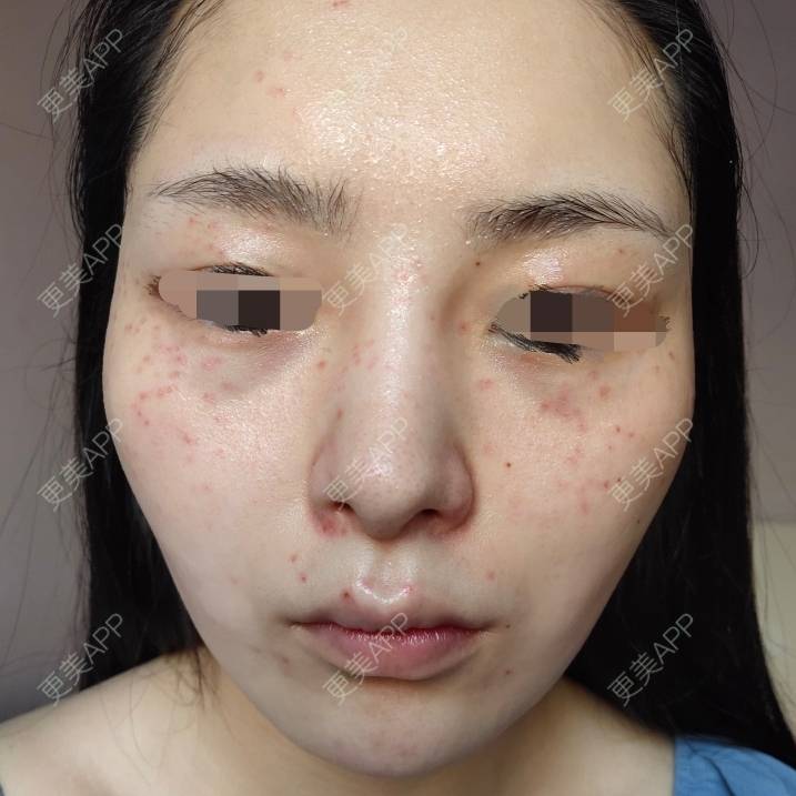更美 - 更美用户mXMhmCcUCG的皮秒激光经验 | 重庆 | 皮秒激光