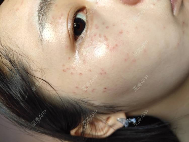 更美 - 更美用户mXMhmCcUCG的皮秒激光经验 | 重庆 | 皮秒激光