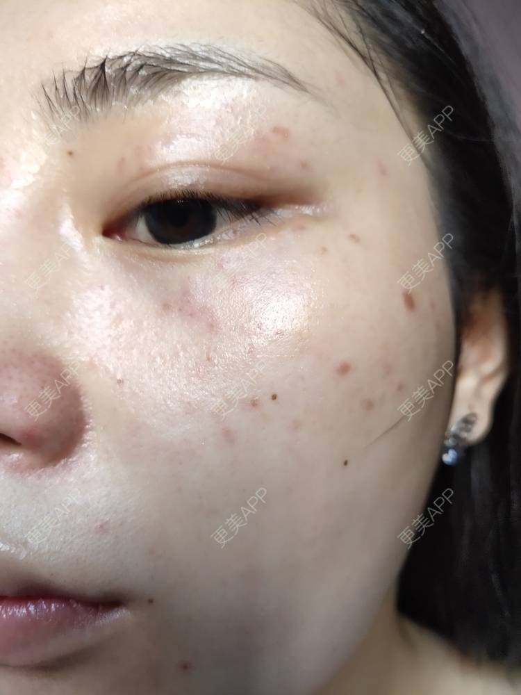 更美 - 更美用户mXMhmCcUCG的皮秒激光经验 | 重庆 | 皮秒激光