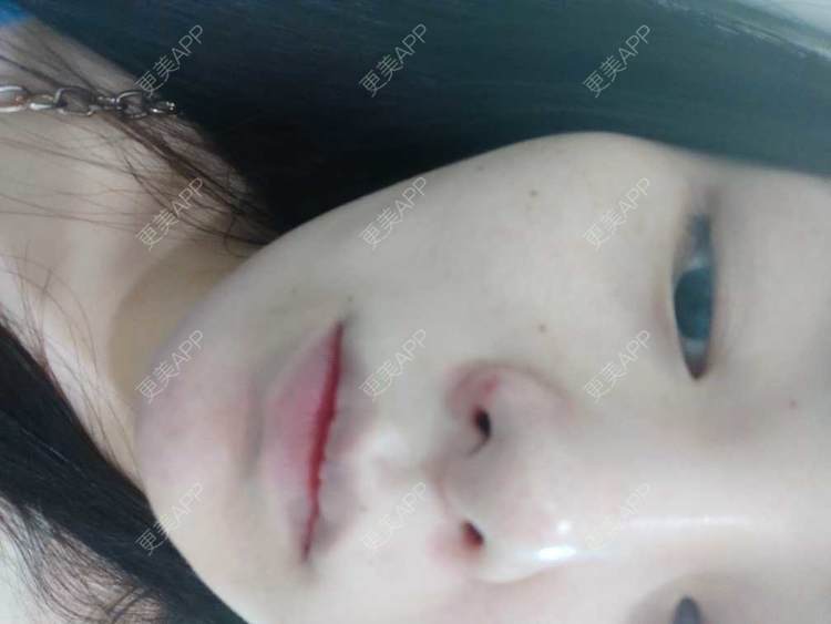 更美 - 更美用户mXMhmCcUCG的皮秒激光经验 | 重庆 | 皮秒激光