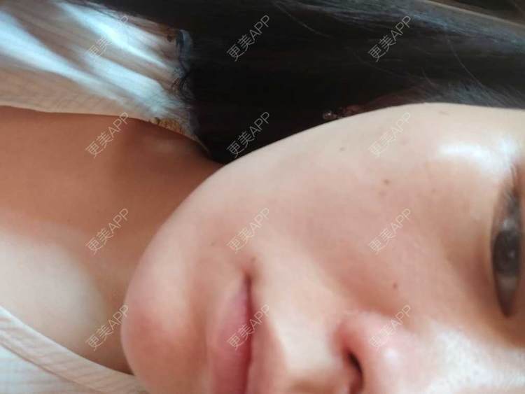 更美 - 更美用户mXMhmCcUCG的皮秒激光经验 | 重庆 | 皮秒激光