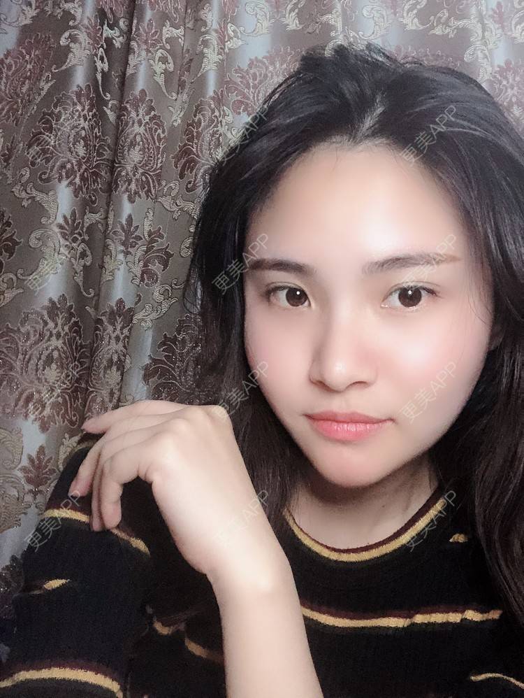更美 - 大美人图的自体脂肪丰额头经验 | 更美研究所 | 杭州 | 自体脂肪丰额头