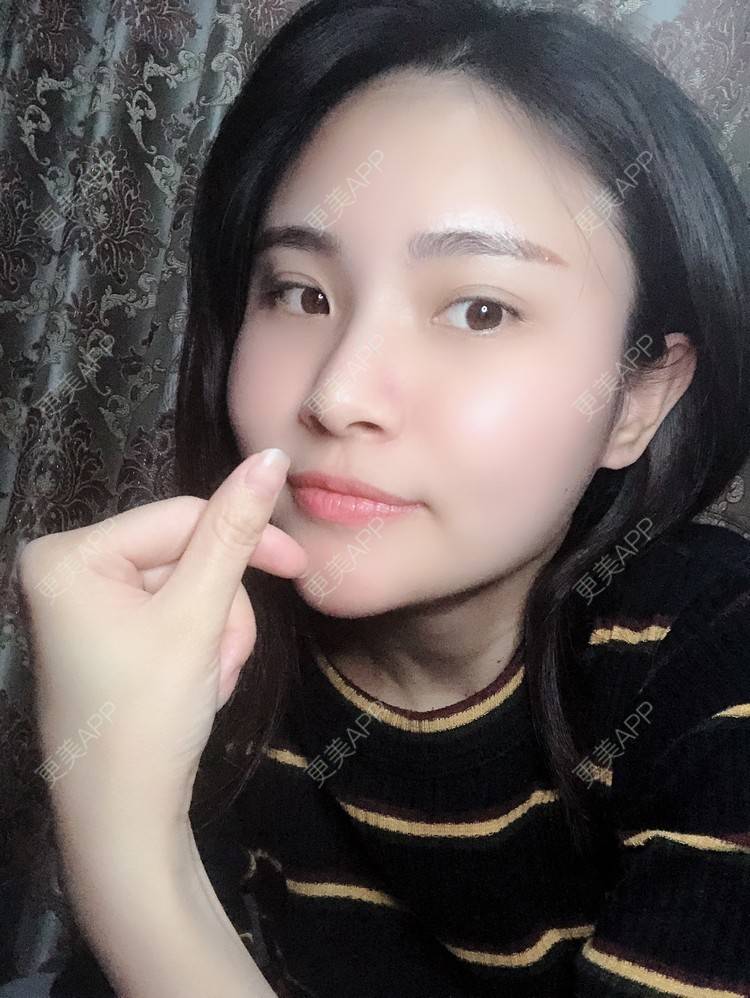 更美 - 大美人图的自体脂肪丰额头经验 | 更美研究所 | 杭州 | 自体脂肪丰额头