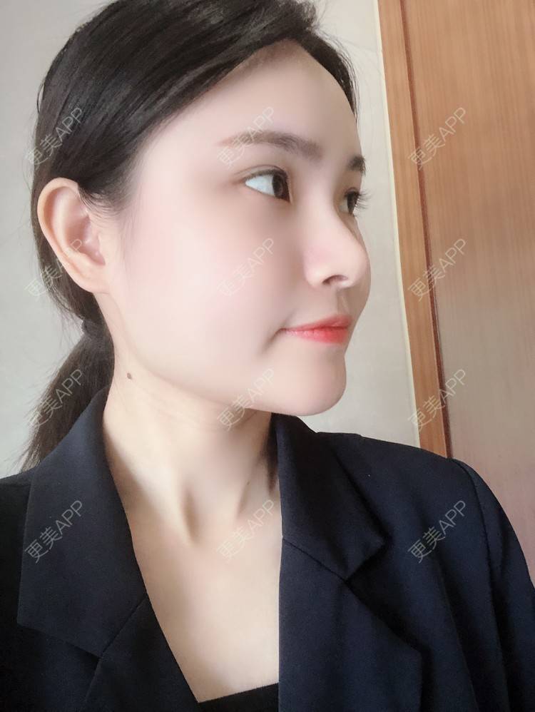 更美 - 大美人图的自体脂肪丰额头经验 | 更美研究所 | 杭州 | 自体脂肪丰额头