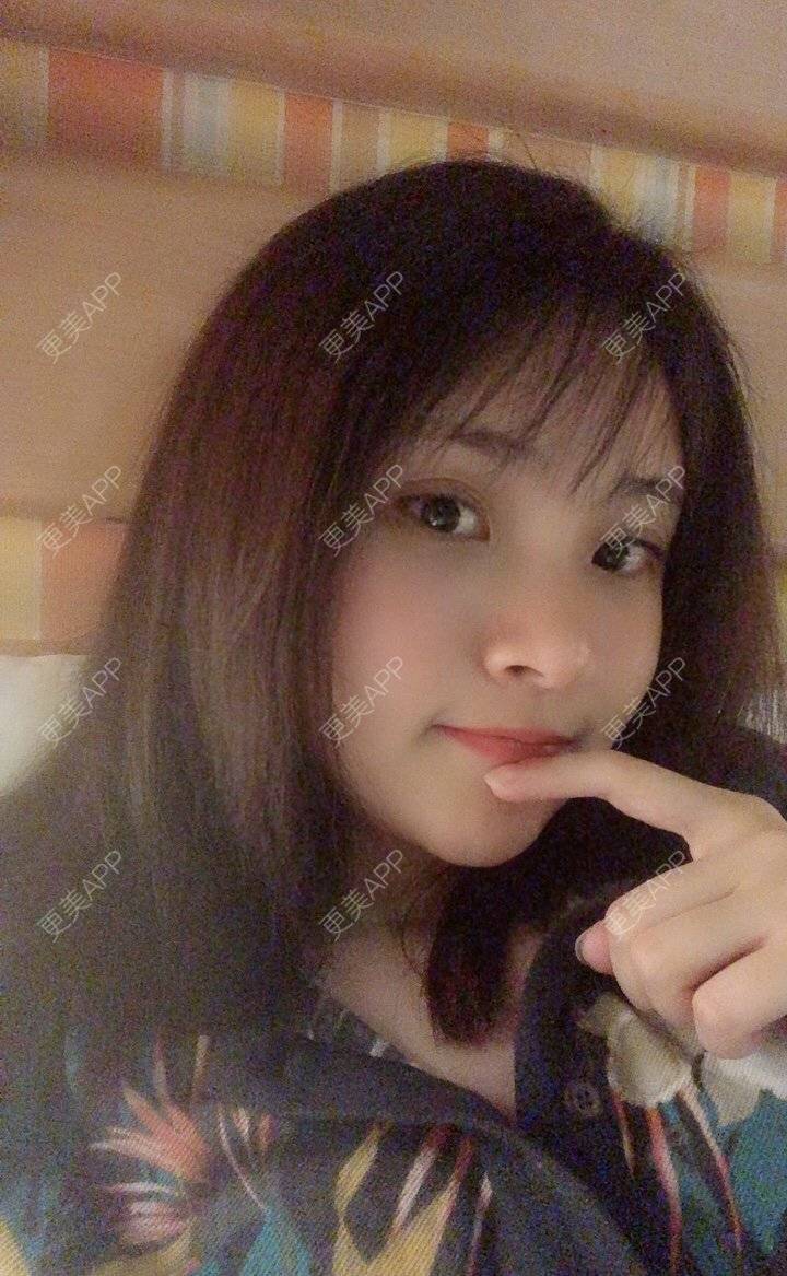 更美 - 大美人图的自体脂肪丰额头经验 | 更美研究所 | 杭州 | 自体脂肪丰额头