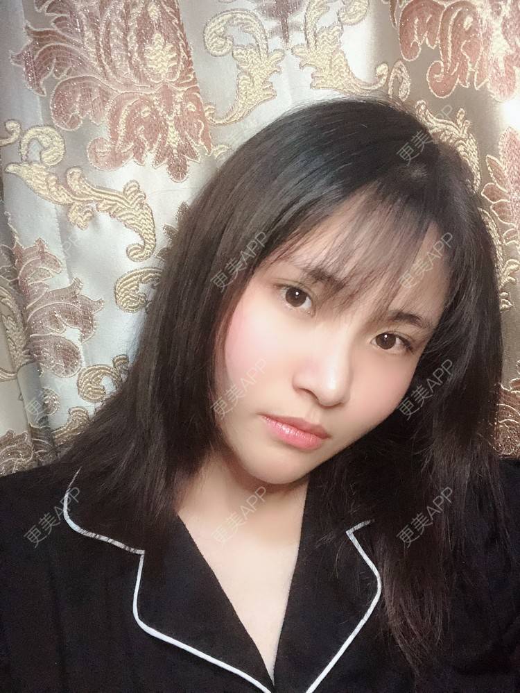 更美 - 大美人图的自体脂肪丰额头经验 | 更美研究所 | 杭州 | 自体脂肪丰额头