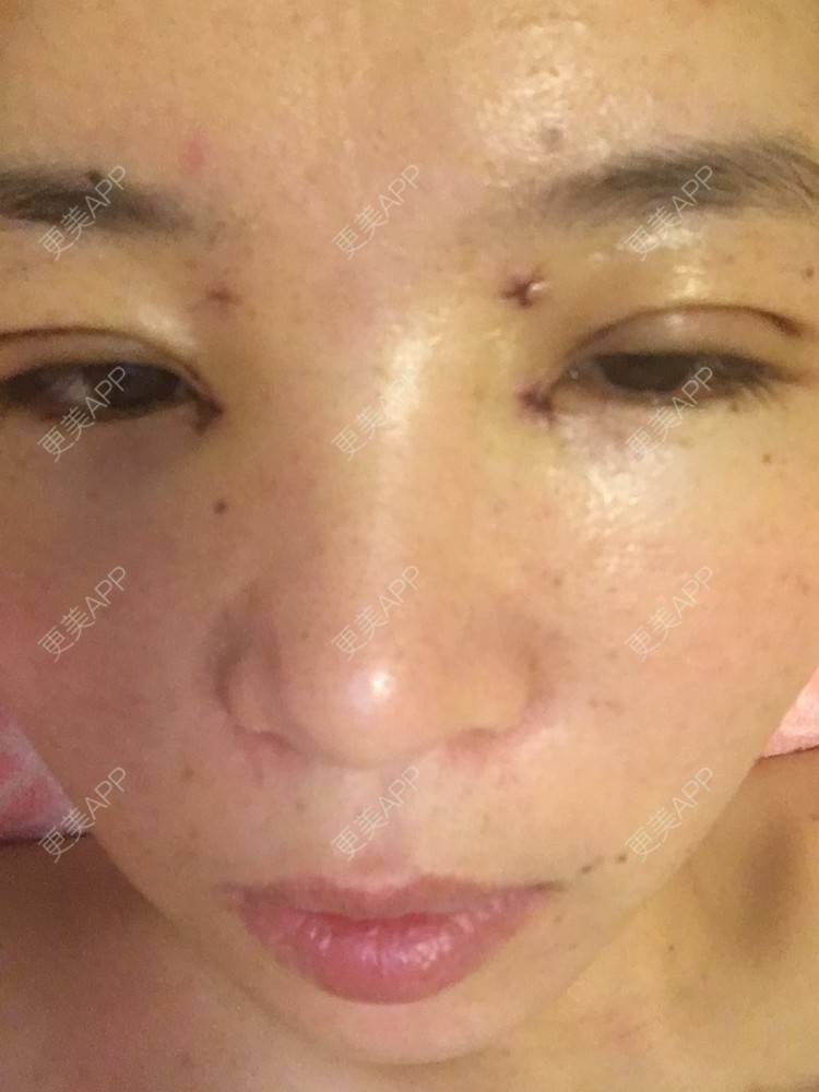 更美 - 更美用户6d6gGsAMox的双眼皮经验 | 双眼皮 | 石家庄