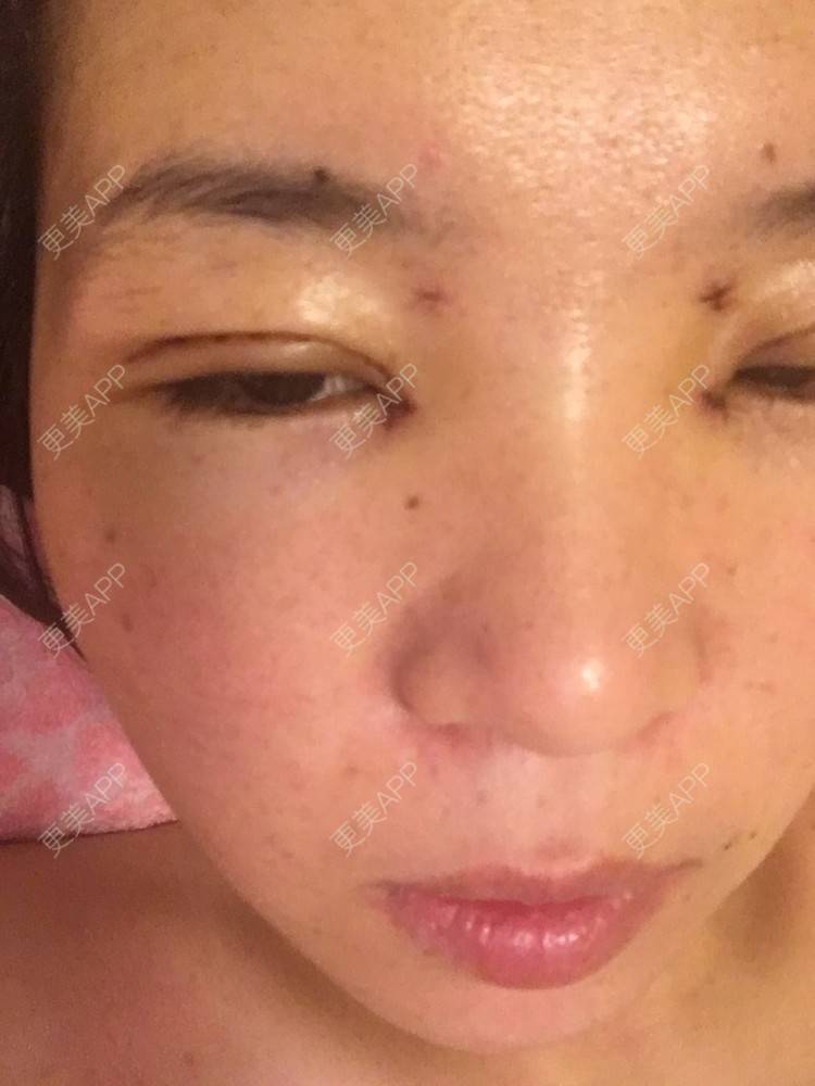 更美 - 更美用户6d6gGsAMox的双眼皮经验 | 双眼皮 | 石家庄