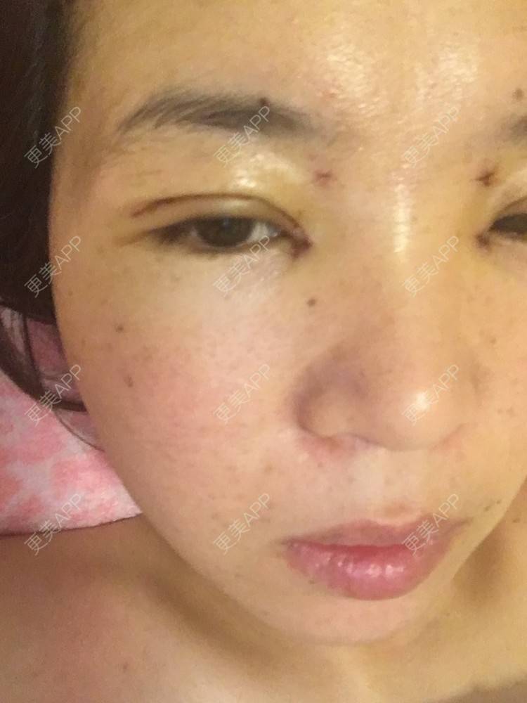 更美 - 更美用户6d6gGsAMox的双眼皮经验 | 双眼皮 | 石家庄