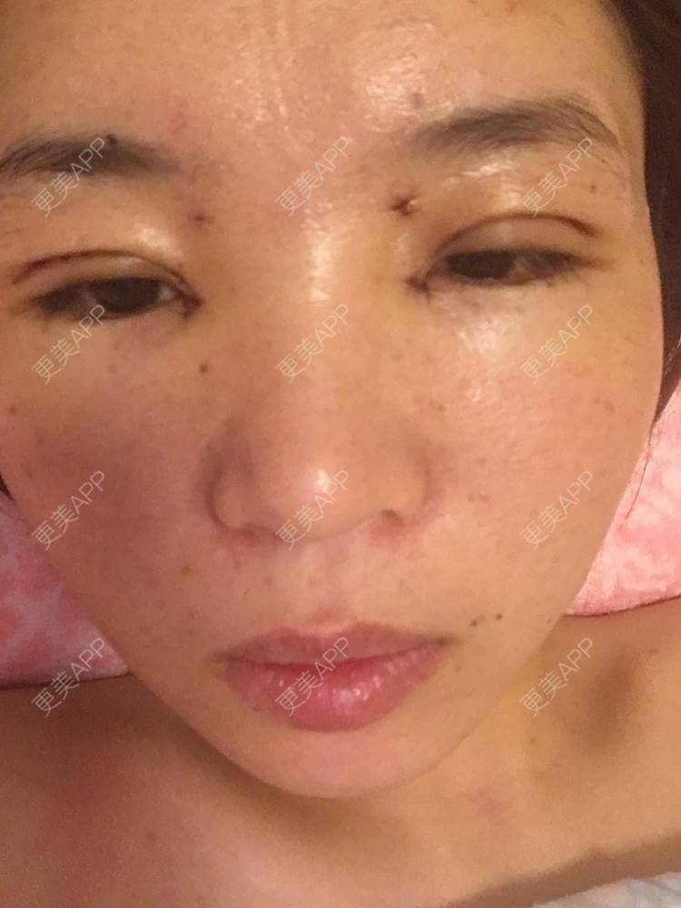 更美 - 更美用户6d6gGsAMox的双眼皮经验 | 双眼皮 | 石家庄