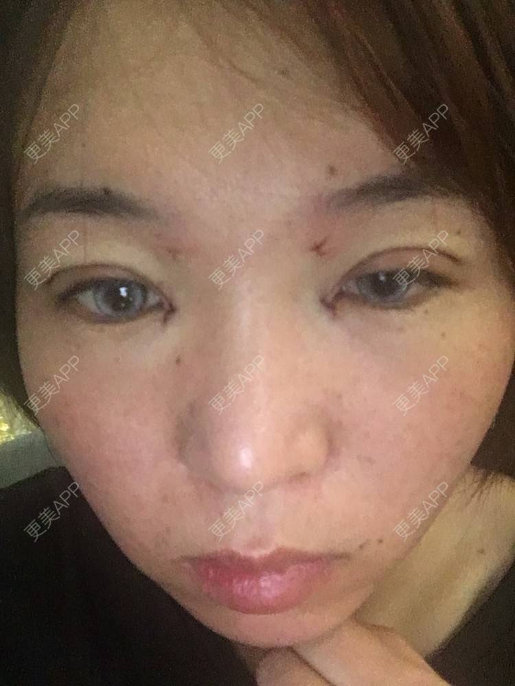 更美 - 更美用户6d6gGsAMox的双眼皮经验 | 双眼皮 | 石家庄