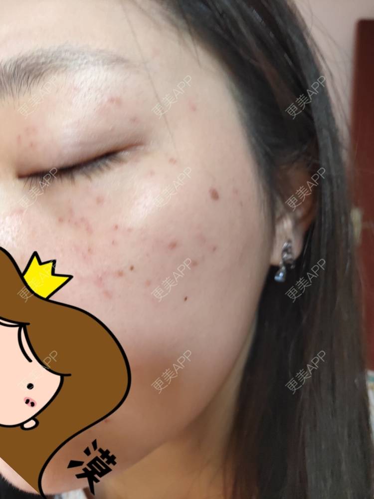 更美 - 更美用户mXMhmCcUCG的皮秒激光经验 | 重庆 | 皮秒激光
