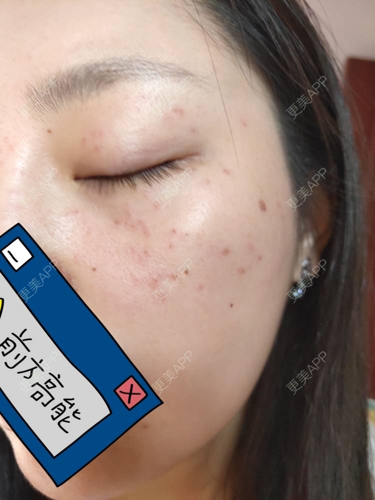 更美 - 更美用户mXMhmCcUCG的皮秒激光经验 | 重庆 | 皮秒激光