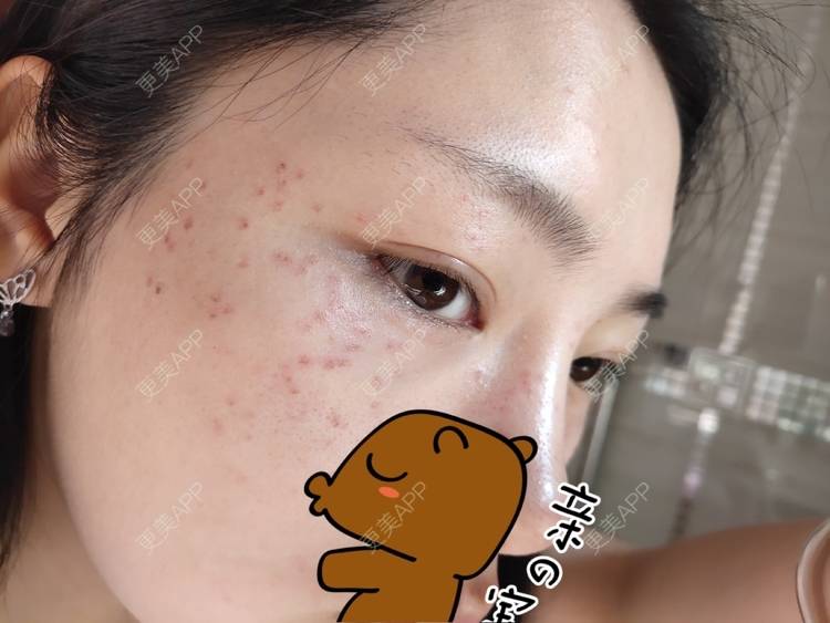 更美 - 更美用户mXMhmCcUCG的皮秒激光经验 | 重庆 | 皮秒激光