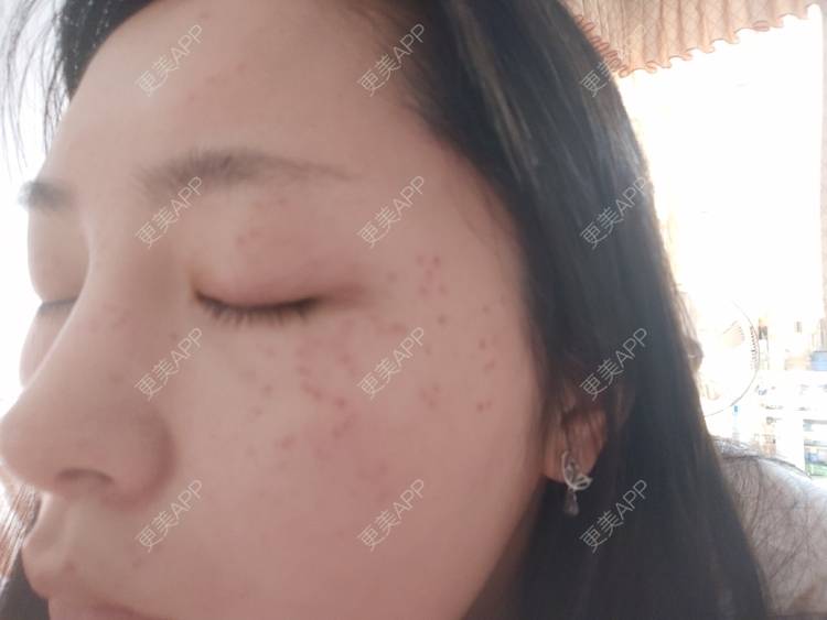 更美 - 更美用户mXMhmCcUCG的皮秒激光经验 | 重庆 | 皮秒激光