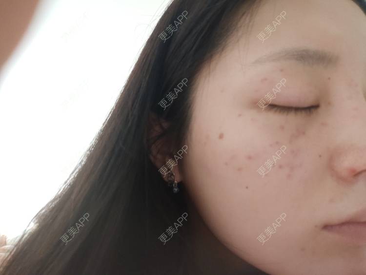 更美 - 更美用户mXMhmCcUCG的皮秒激光经验 | 重庆 | 皮秒激光