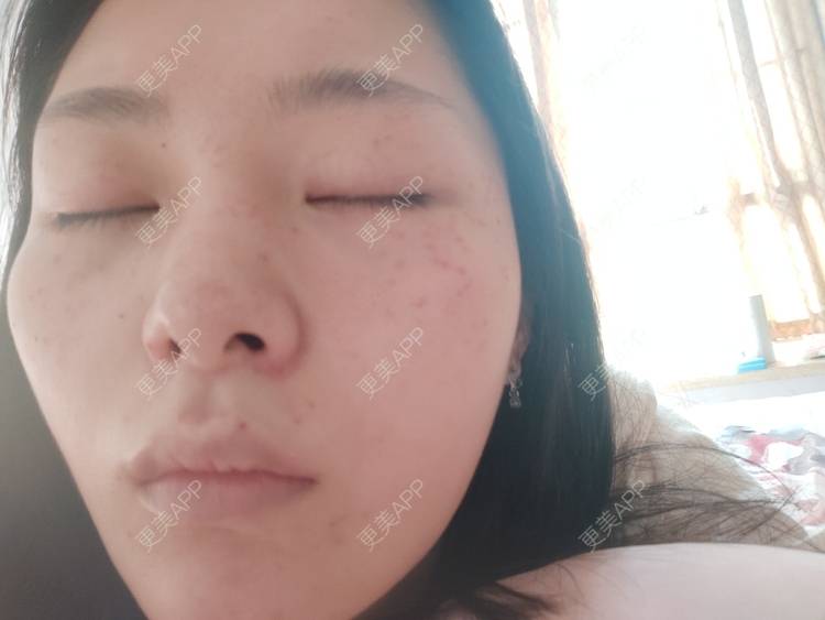 更美 - 更美用户mXMhmCcUCG的皮秒激光经验 | 重庆 | 皮秒激光