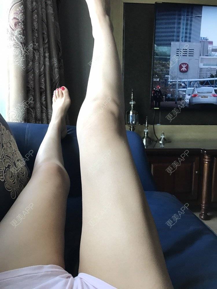 更美 - 慢漫曼小姐的吸脂瘦大腿经验 | 吸脂瘦大腿 | 宁波