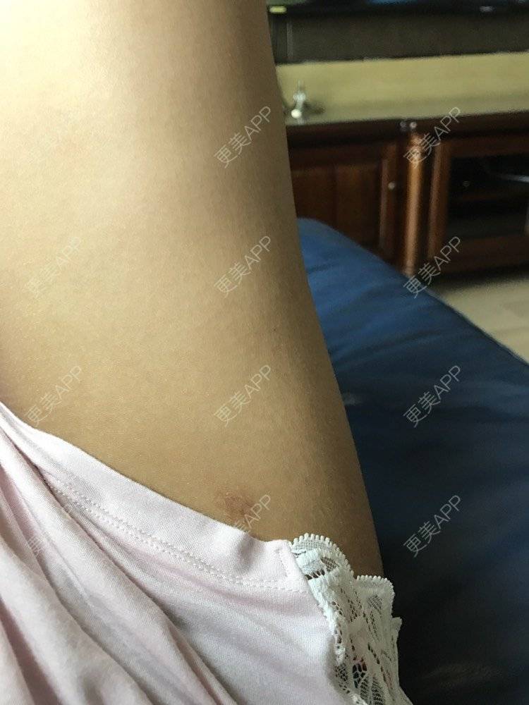 更美 - 慢漫曼小姐的吸脂瘦大腿经验 | 吸脂瘦大腿 | 宁波