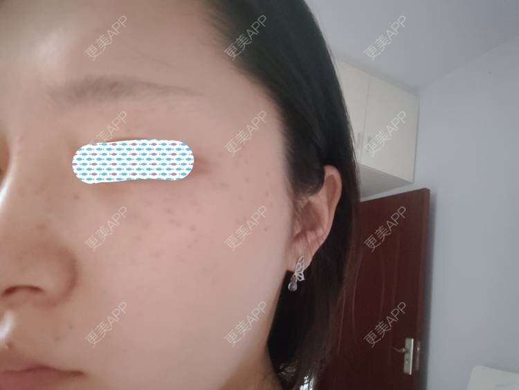 更美 - 更美用户mXMhmCcUCG的皮秒激光经验 | 皮秒激光 | 重庆