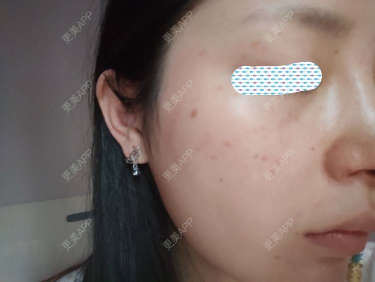 更美 - 更美用户mXMhmCcUCG的皮秒激光经验 | 皮秒激光 | 重庆