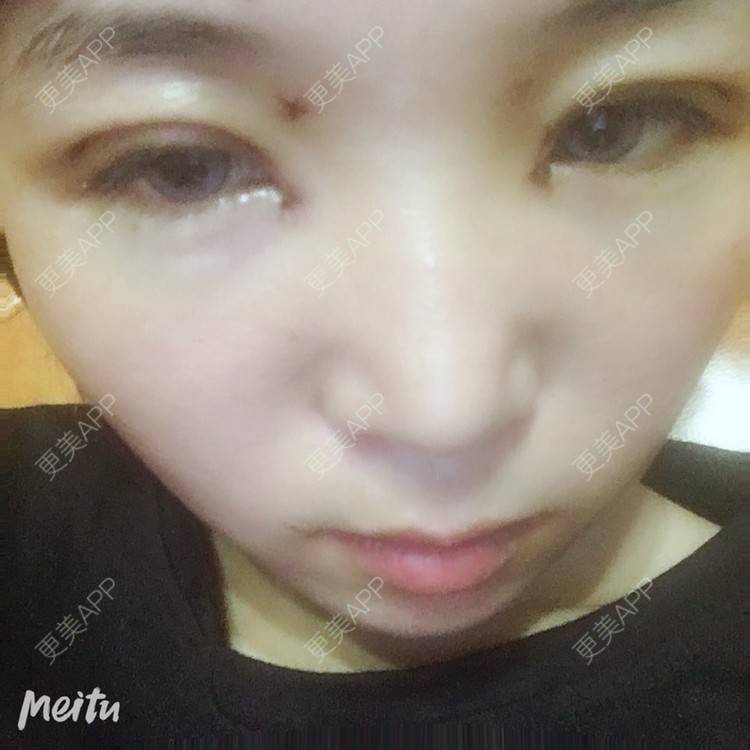 更美 - 更美用户6d6gGsAMox的双眼皮经验 | 双眼皮 | 石家庄