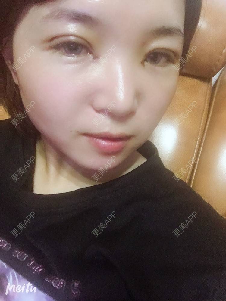 更美 - 更美用户6d6gGsAMox的双眼皮经验 | 双眼皮 | 石家庄