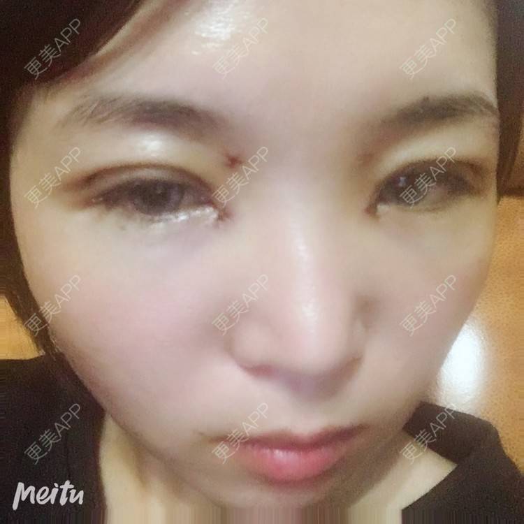 更美 - 更美用户6d6gGsAMox的双眼皮经验 | 双眼皮 | 石家庄