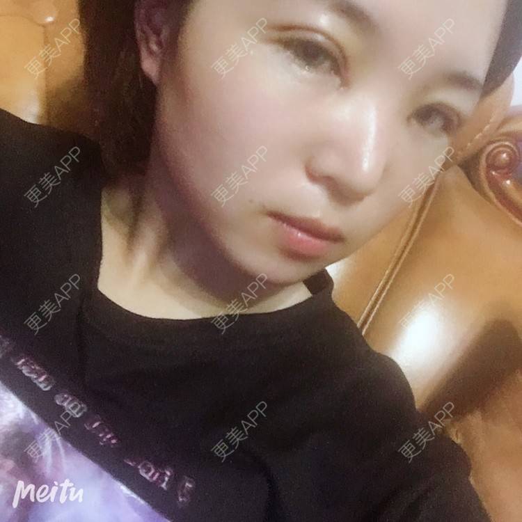 更美 - 更美用户6d6gGsAMox的双眼皮经验 | 双眼皮 | 石家庄