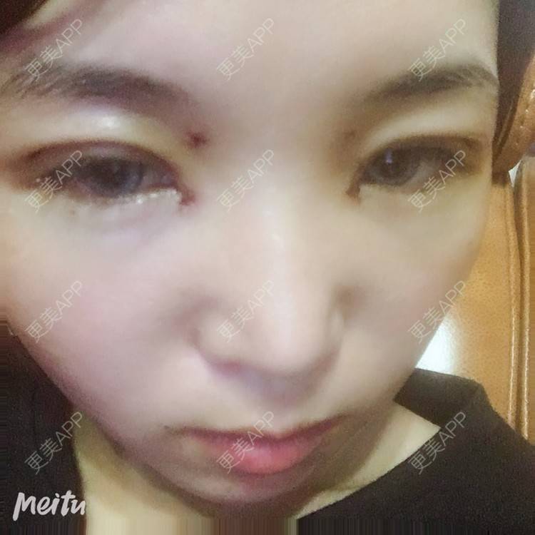 更美 - 更美用户6d6gGsAMox的双眼皮经验 | 双眼皮 | 石家庄