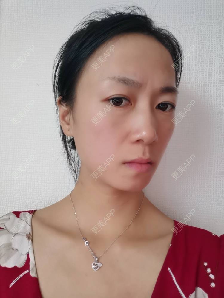 更美 - 更美用户y1zfD0qgXq的玻尿酸苹果肌经验 | 玻尿酸苹果肌 | 抚州