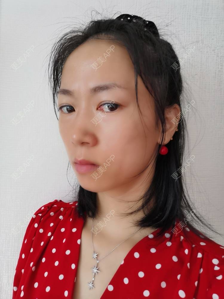 更美 - 更美用户y1zfD0qgXq的玻尿酸苹果肌经验 | 玻尿酸苹果肌 | 抚州